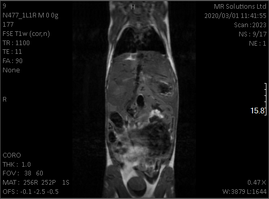 mri_liver